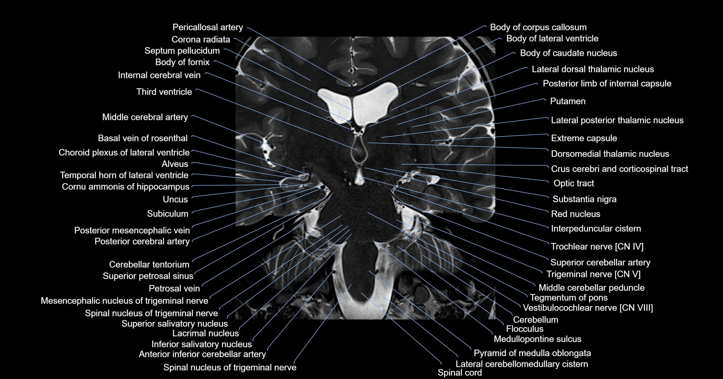 MRI brainstem & basal ganglia anatomy labelled 3T MRI images -img-00001-00022.webp